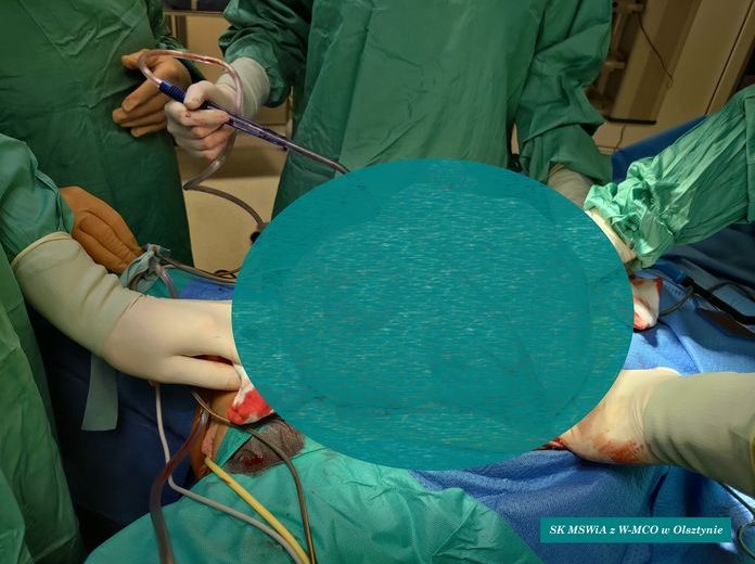 Operacja wycięcia torbieli jajników